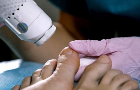 Uklanjanje gljivica na noktima laserom